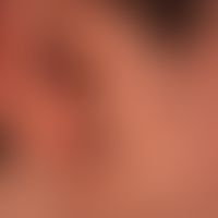 Naevus, epidermaler:&nbsp;seit Geburt bestehende, erhabene, symptomlose, linear angeordnete, plan...