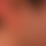 Naevus, epidermaler:&nbsp;seit Geburt bestehende, erhabene, symptomlose, linear angeordnete, plan...