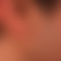 Naevus, epidermaler:&nbsp;seit Geburt bestehende, erhabene, symptomlose, linear angeordnete, plan...