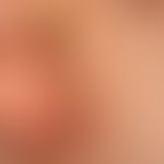 Naevus, epidermaler:&nbsp;seit Geburt bestehende, erhabene, symptomlose, linear angeordnete, plan...