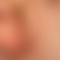 Naevus, epidermaler:&nbsp;seit Geburt bestehende, erhabene, symptomlose, linear angeordnete, plan...