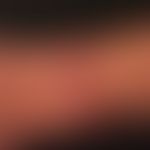 Molluscum contagiosum:&nbsp;disseminierte, 0,1-0,7 cm große, feste, derbe, breit aufsitzende,&nbs...