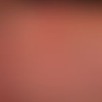 Hodgkin-Lymphom, Hautveränderungen:&nbsp;Mollusca contagiosa, disseminierte Auftreten&nbsp; bei H...