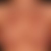 Lupus erythematodes tumidus:&nbsp;seit mehreren Jahren chronisch rezidivierendes Krankheitsbild. ...