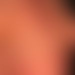 Lupus erythematodes tumidus:&nbsp;seit mehreren Jahren chronisch rezidivierendes Krankheitsbild. ...