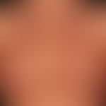 Differenzialdiagnose: REM-Syndrom

Diagnose: Lupus erythematodes tumidus&nbsp;(seit mehreren Jahr...