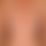 Differenzialdiagnose: Lupus erythematodes tumidus&nbsp;

Diagnose:&nbsp;REM-Syndrom.&nbsp;In typi...