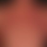 Pemphigus vulgaris:&nbsp;multiple, chronische, seit 3 Jahren schubweise verlaufende, symmetrische...
