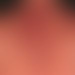 Pemphigus vulgaris:&nbsp;multiple, chronische, seit 3 Jahren schubweise verlaufende, symmetrische...