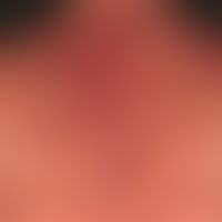 Pemphigus vulgaris:&nbsp;multiple, chronische, seit 3 Jahren schubweise verlaufende, symmetrische...