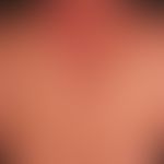 Pemphigus vulgaris:&nbsp;multiple, chronische, seit 3 Jahren schubweise verlaufende, symmetrische...