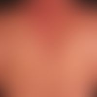 Pemphigus vulgaris:&nbsp;multiple, chronische, seit 3 Jahren schubweise verlaufende, symmetrische...