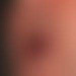 Pemphigus vulgaris: flächenhafte, schmerzende&nbsp;Erosionen am weichen und harten Gaumen
