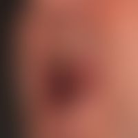 Pemphigus vulgaris: flächenhafte, schmerzende&nbsp;Erosionen am weichen und harten Gaumen
