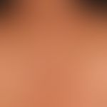 Pemphigus vulgaris: multiple, chronische, seit 3 Jahren schubweise verlaufende, symmetrische, sta...