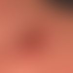Pemphigus vulgaris: ältere, nicht vorbehandelte, Läsion - akantholytische Blase mit Resten der Bl...