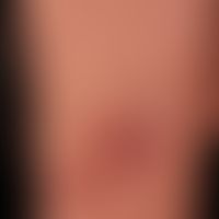 Pemphigus vulgaris:&nbsp;multiple, chronische, seit mehreren&nbsp;Jahren schubweise verlaufende, ...