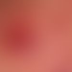 Pemphigus vulgaris: ältere, nicht vorbehandelte, erosive Läsion - akantholytische Blase mit Reste...