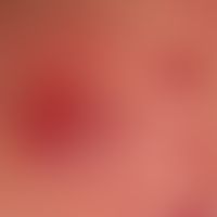 Pemphigus vulgaris: ältere, nicht vorbehandelte, erosive Läsion - akantholytische Blase mit Reste...