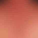 Pemphigus vulgaris:&nbsp;multiple, chronische, seit 3 Jahren schubweise verlaufende, symmetrische...