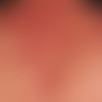 Pemphigus vulgaris:&nbsp;multiple, chronische, seit 3 Jahren schubweise verlaufende, symmetrische...