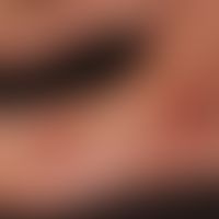 Livedovaskulopathie:&nbsp;bizarre, stark schmerzhafte PLaque und Ulzera und hämorrhagische Plaque...