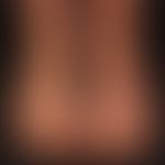 Livedovaskulopathie: hämorrhagisch-nekrotische Lasionen auf erythematösem Grund. Abheilung unter ...