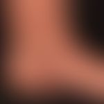 Livedovaskulopathie:&nbsp;livide schmerzhafte Lasionen auf erythematösem Grund. Periulzeröses Liv...