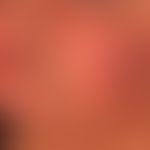 Angioödem:&nbsp;innerhalb weniger Minuten aufgetretene Schwellung der Lippen sowie der Wangenregi...