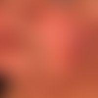 Angioödem:&nbsp;innerhalb weniger Minuten aufgetretene Schwellung der Lippen sowie der Wangenregi...