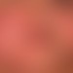 Angioödem:&nbsp;innerhalb weniger Minuten aufgetretene Schwellung der Lippen (halbseitig) sowie d...