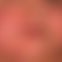 Angioödem:&nbsp;innerhalb weniger Minuten aufgetretene Schwellung der Lippen (halbseitig) sowie d...
