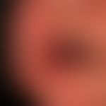 Angioödem:&nbsp;innerhalb weniger Minuten aufgetretene Schwellung der Lippen (halbseitig) sowie d...