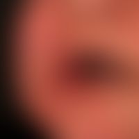 Angioödem:&nbsp;innerhalb weniger Minuten aufgetretene Schwellung der Lippen (halbseitig) sowie d...