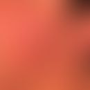 Teleangiektasie. Netzförmig verzweigte, unregelmäßige kapilläre Gefäßerweiterungen im Wangenberei...