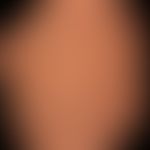 Varize retikuläre (Besenreiser):&nbsp;dunkel-blaurote, 0,5-2,0 mm breite, geschlängelte Varizenst...