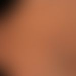 Varize retikuläre (Besenreiser):&nbsp;dunkel-blaurote, 0,5-2,0 mm breite, geschlängelte Varizenst...