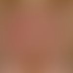 Differenzialdiagnose:&nbsp;Dermatitis solaris&nbsp;

Diagnose: Subakut-kutaner Lupus erythematode...