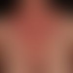 Differenzialdiagnose:&nbsp;Dermatitis solaris&nbsp;

Diagnose: Atopische Dermatitis (intrinsiche ...