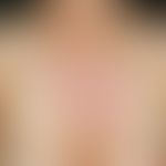 Differenzialdiagnose:&nbsp;Dermatitis solaris&nbsp;

Diagnose: REM-Syndrom

Keine UV-Induktion.&n...