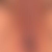 Generalisierte&nbsp;atopische&nbsp;Dermatitis: chronische, permanent&nbsp; juckende, unscharf beg...