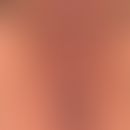 Vulvadermatitis atopische: Flächenhafte chronische Dermatitis der vulvären Hautpartien, verbunden...