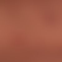 Pityriasis lichenoides chronica. Detailaufnahme. Sehr polymorphes Bild mit&nbsp; unterschiedlich&...