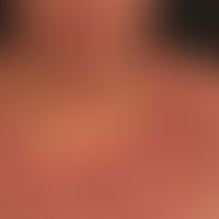 Extrinsische&nbsp;atopische&nbsp;Dermatitis: eminent&nbsp;chronische Ekzembild mit unscharf begre...
