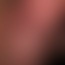 Frühsyphilis: Primäraffekt
