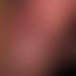 Syphilis acquisita:&nbsp;solitäres, akutes, indolentes, derbes Ulkus bei einem 20-Jährigen , weni...