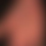 Syphilis acquisita:&nbsp;makulo-papulöses Exanthem, psoriasiformes Palmarsyphilid.

&nbsp;
