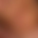Tinea capitis superficialis: seit mehreren Monaten bestehender langsam zentrifugal wachsender Her...