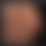 Mykid: generalisiertes makulo-papulöses Exanthem bei ausgeprägter Tinea capitis.
