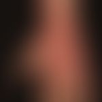 Skleromyxödem: flächige Induration und Rötung der Handrücken.
